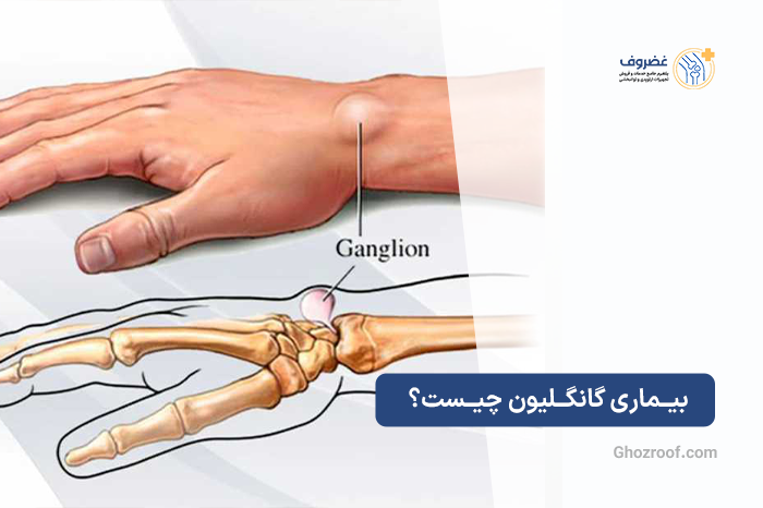 بیماری-گانگلیون-چیست؟