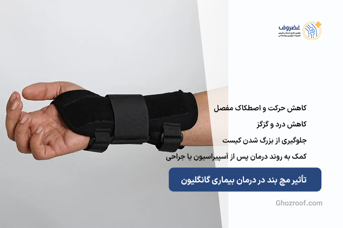 تأثیر-مچ-بند-در-درمان-بیماری-گانگلیون