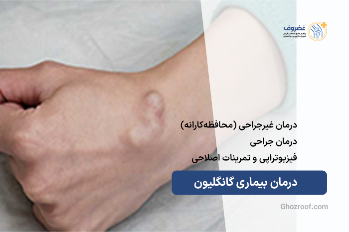 درمان-بیماری-گانگلیون