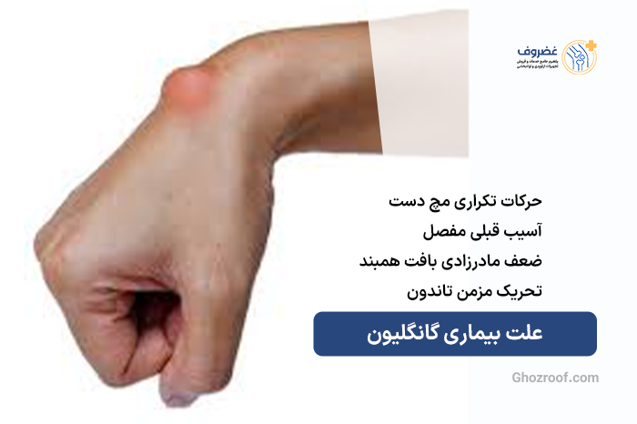علت-بیماری-گانگلیون